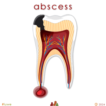w33997_01 abscess