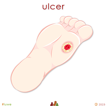 z32583_01 ulcer